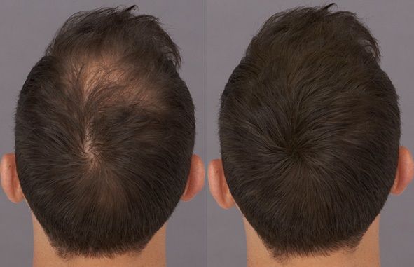 Tratamiento Capilar Masculino